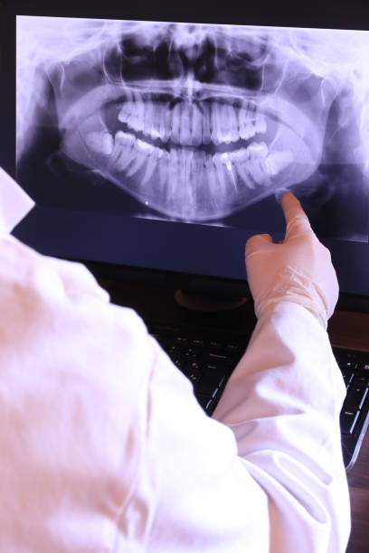 Best Emergency Wisdom Tooth Extraction in St Pete Beach, FL